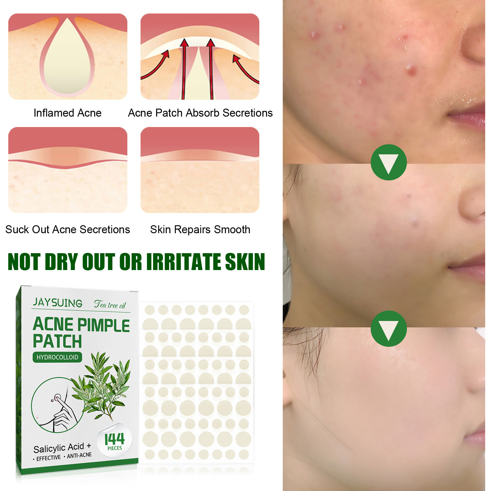 Acne Pimple Patches Translucen - Herbal Wellness Tea review and price